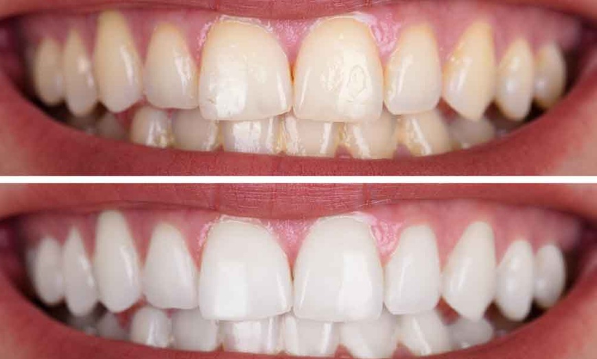 Image 1: Refresh Your Teeth with 30, 45, or 60-minute Teeth Whitening Treatment