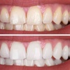 Image 1: Refresh Your Teeth with 30, 45, or 60-minute Teeth Whitening Treatment