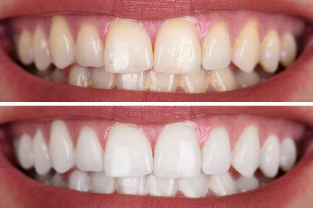 Refresh Your Teeth with 30, 45, or 60-minute Teeth Whitening Treatment