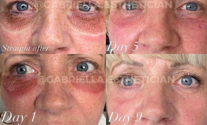 Image 5: Fibroblast Plasma Pen Lifts for Face and Neck