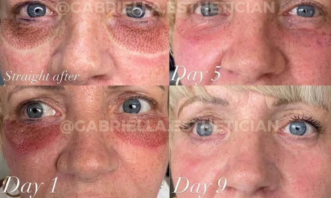 Fibroblast Plasma Pen Lifts for Face and Neck