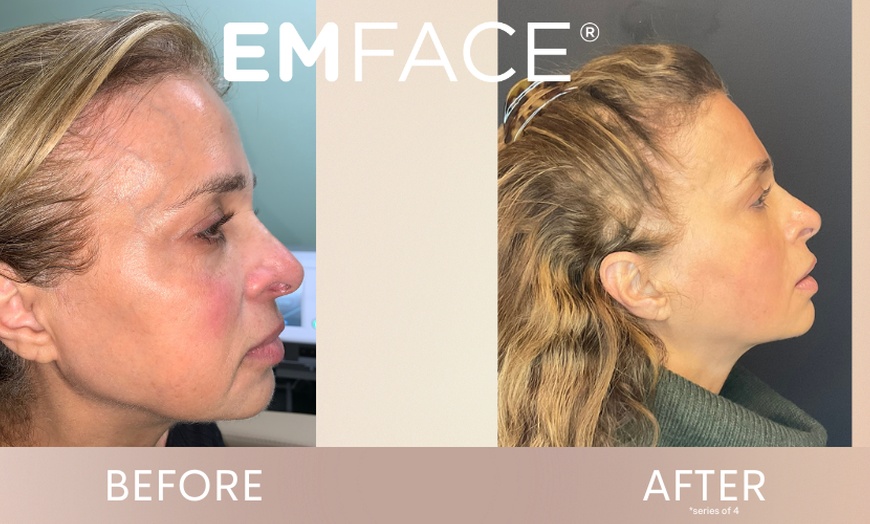 Image 3: Up to 37% Off on Facelift - Non-Surgical at Total Body Aesthetics
