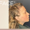 Image 3: Up to 37% Off on Facelift - Non-Surgical at Total Body Aesthetics