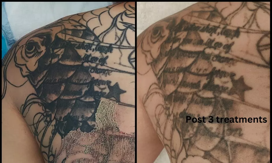 Effective Laser Tattoo Removal Sessions for Various Sizes