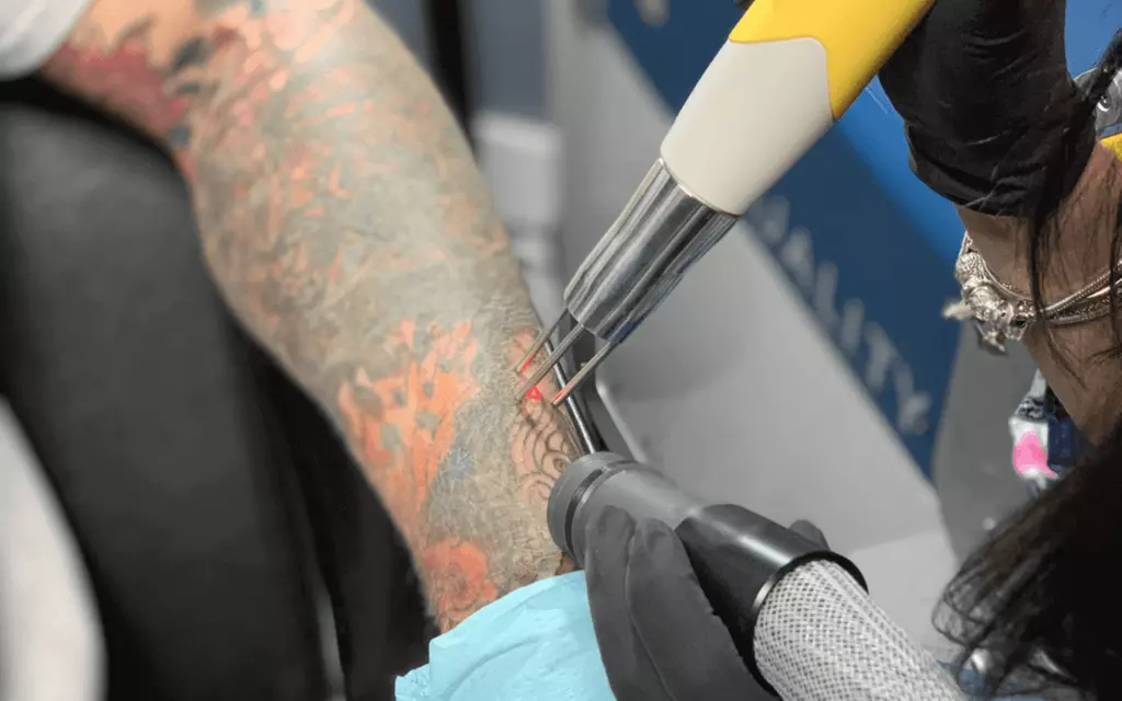 Up to 60% Off on Laser Tattoo Removal at Vitality Spa - Primary Image