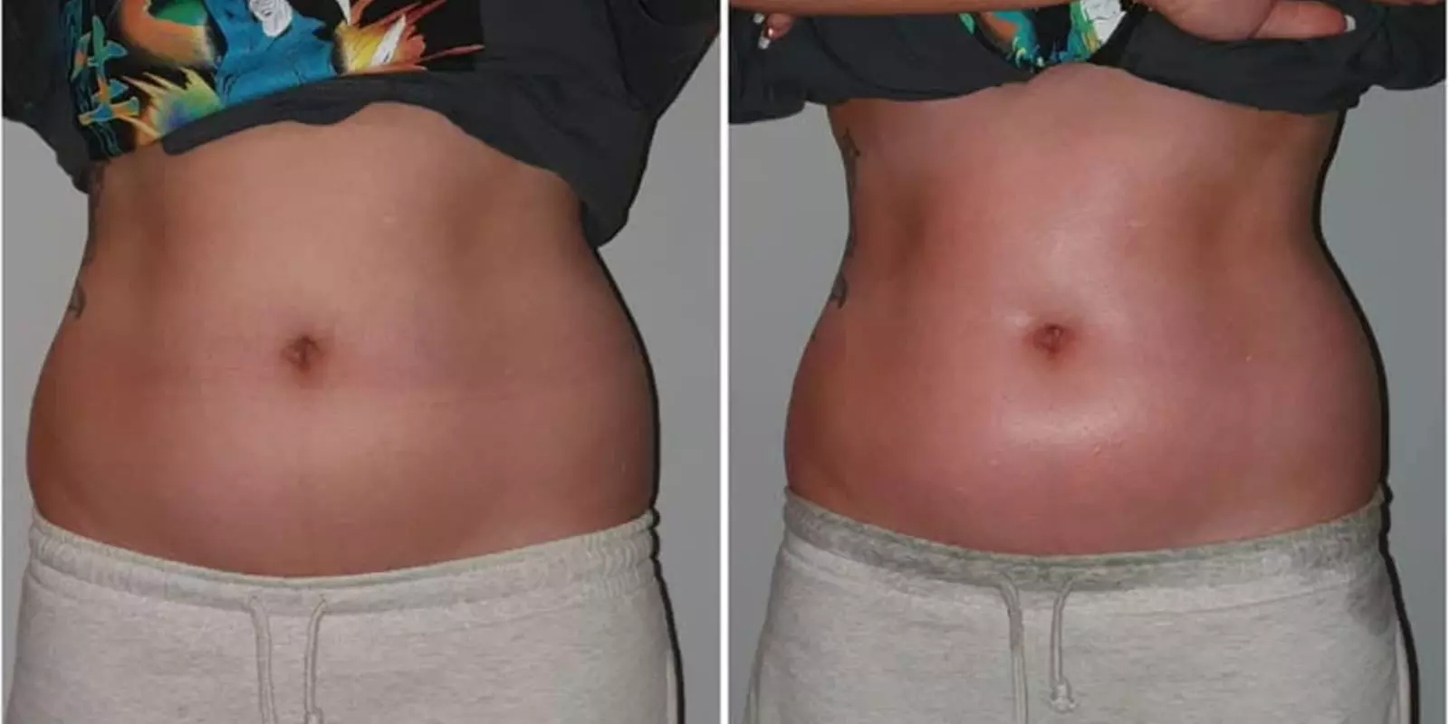 Get Your Body Summer Ready with Advanced Body Sculpting