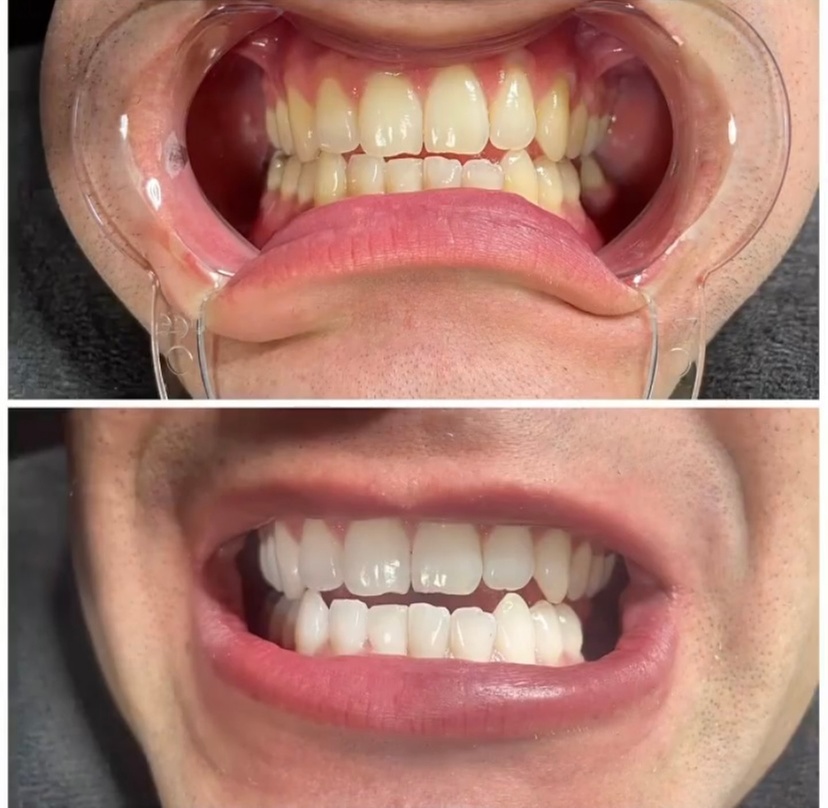 Get a Brighter Smile with Zoom Teeth Whitening Treatment