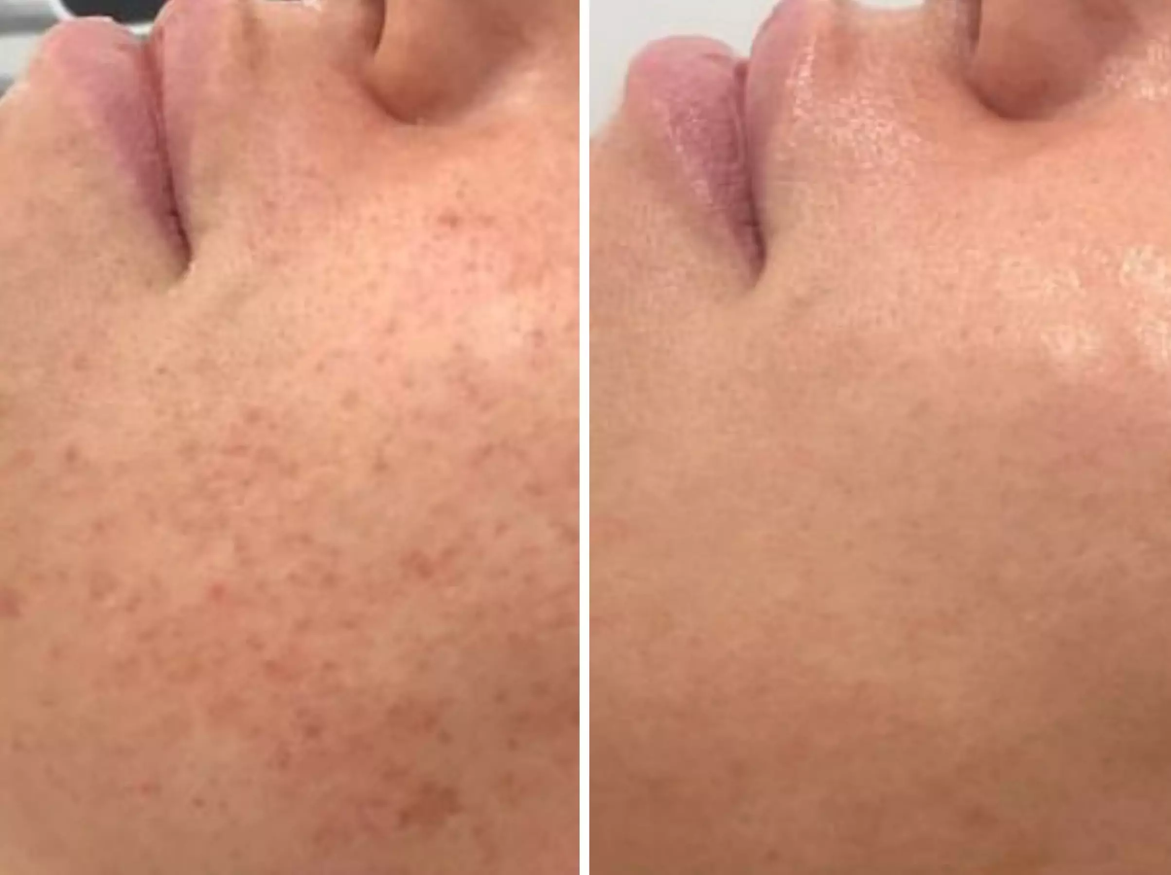 Up to 69% Off on HydraFacial at Skin & Laser Aesthetics