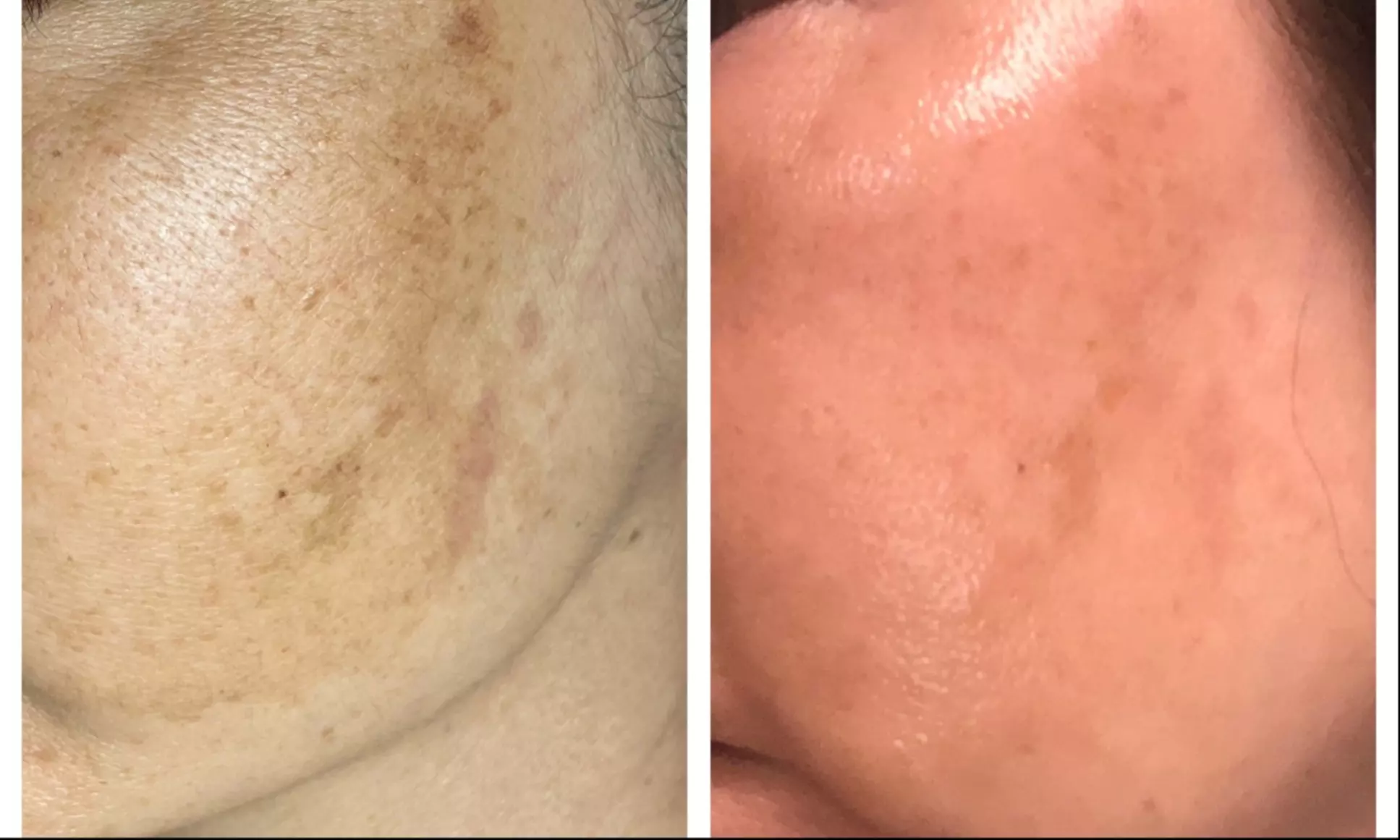 Revitalize Your Skin with Customized Facial and Peels