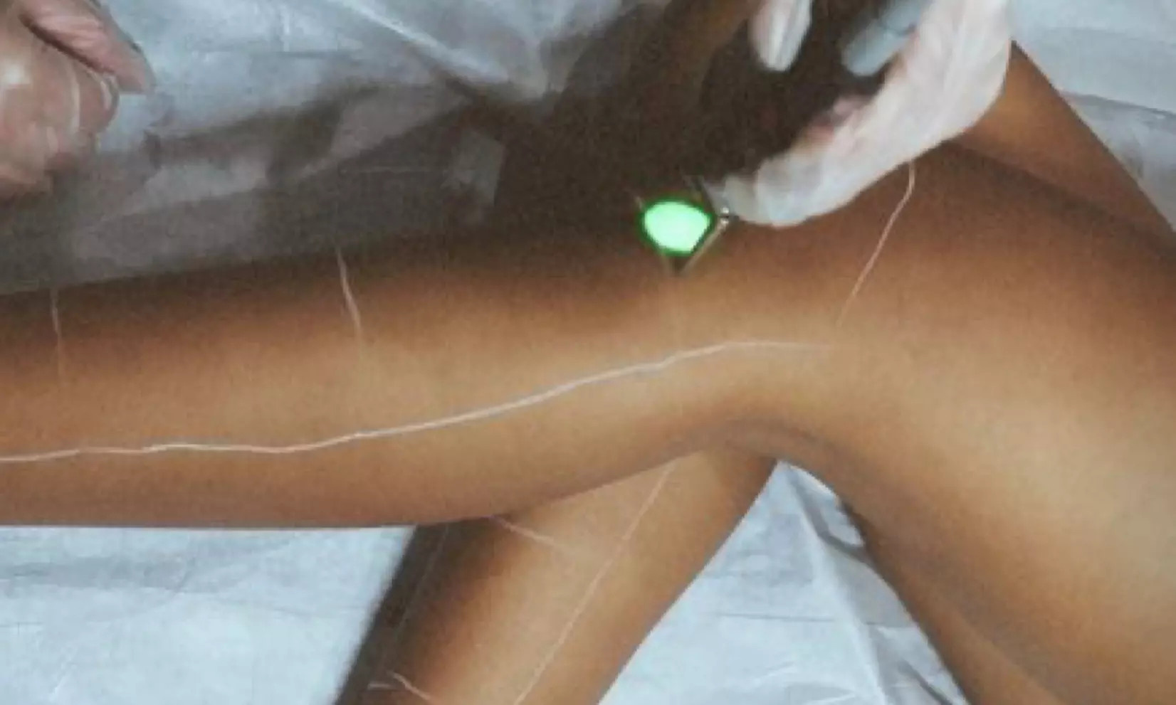 Experience Laser Hair Removal with Customized Options