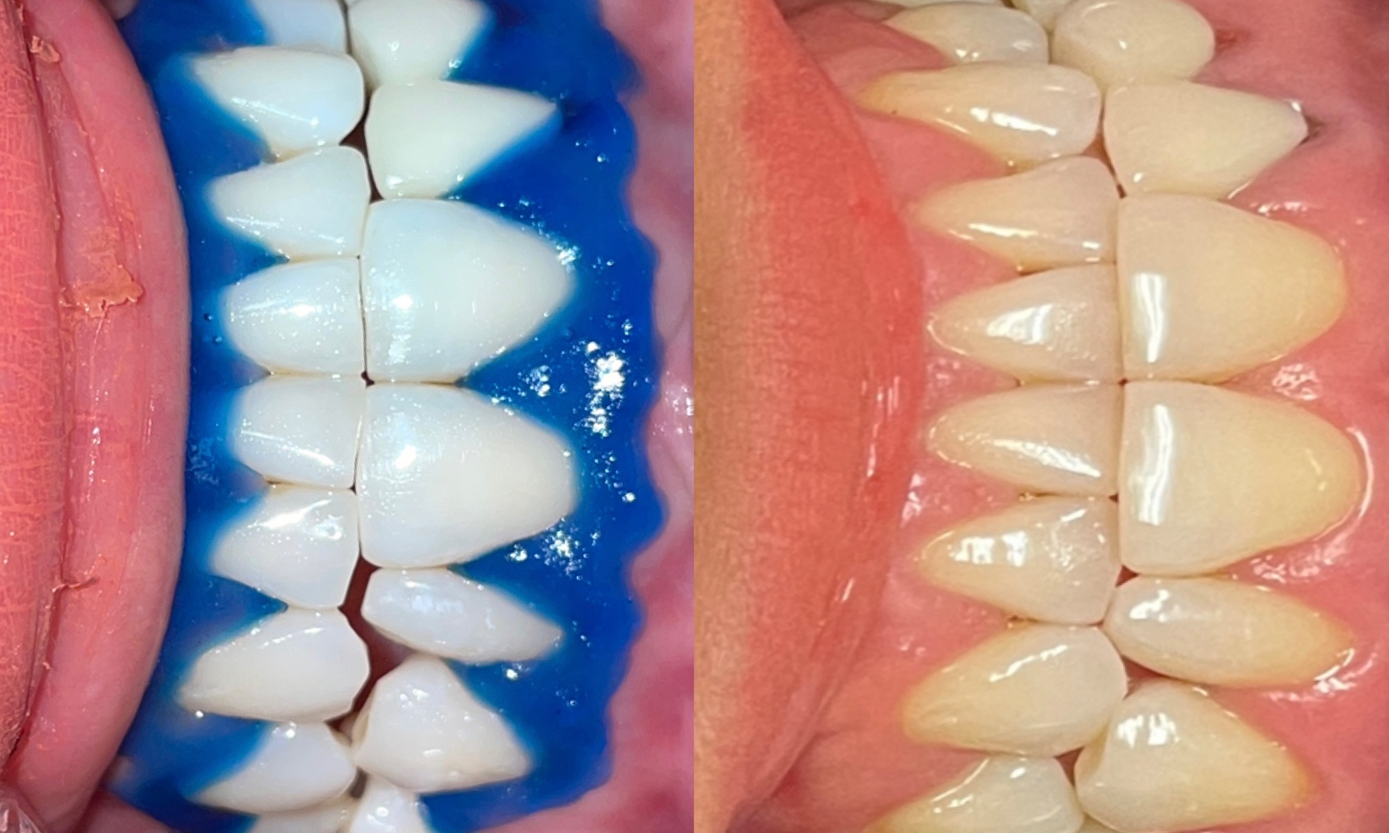 Get a Brighter Smile with Various Teeth Whitening Options