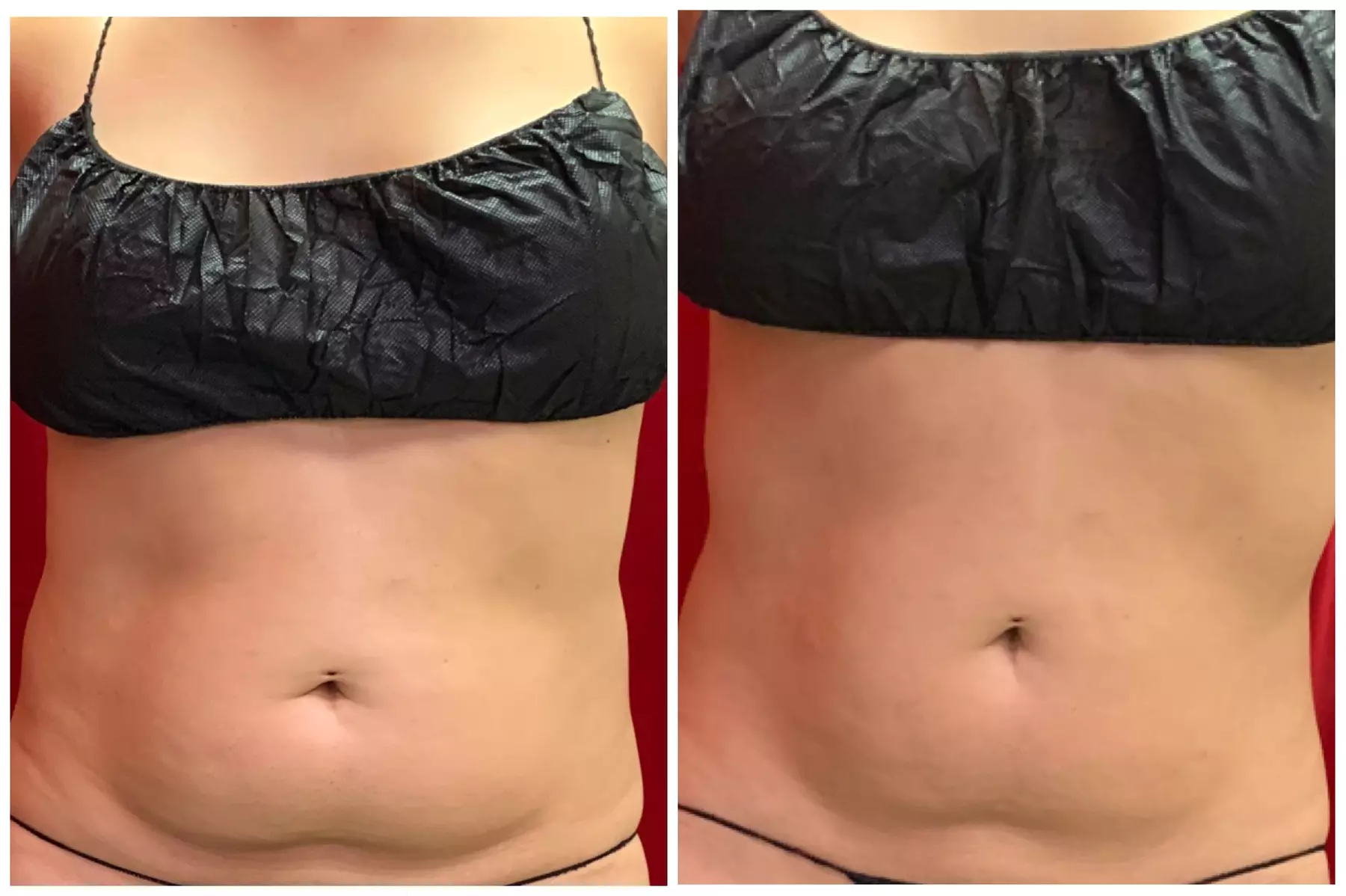 Up to 46% Off on Cavitation at A-List Body - Primary Image