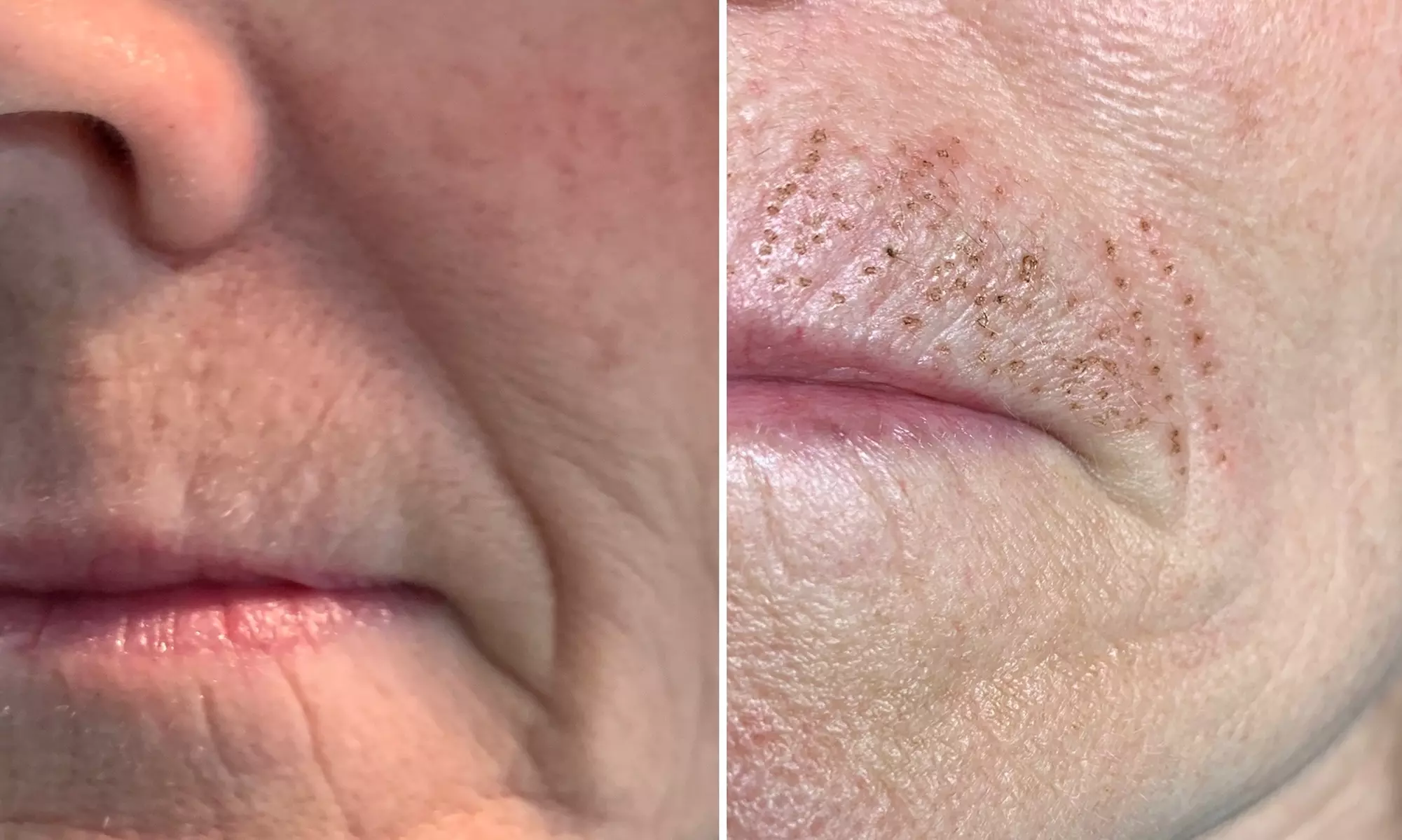 Up to 45% Off on Facelift - Non-Surgical at Bella Joli Esthetique - Second Medium