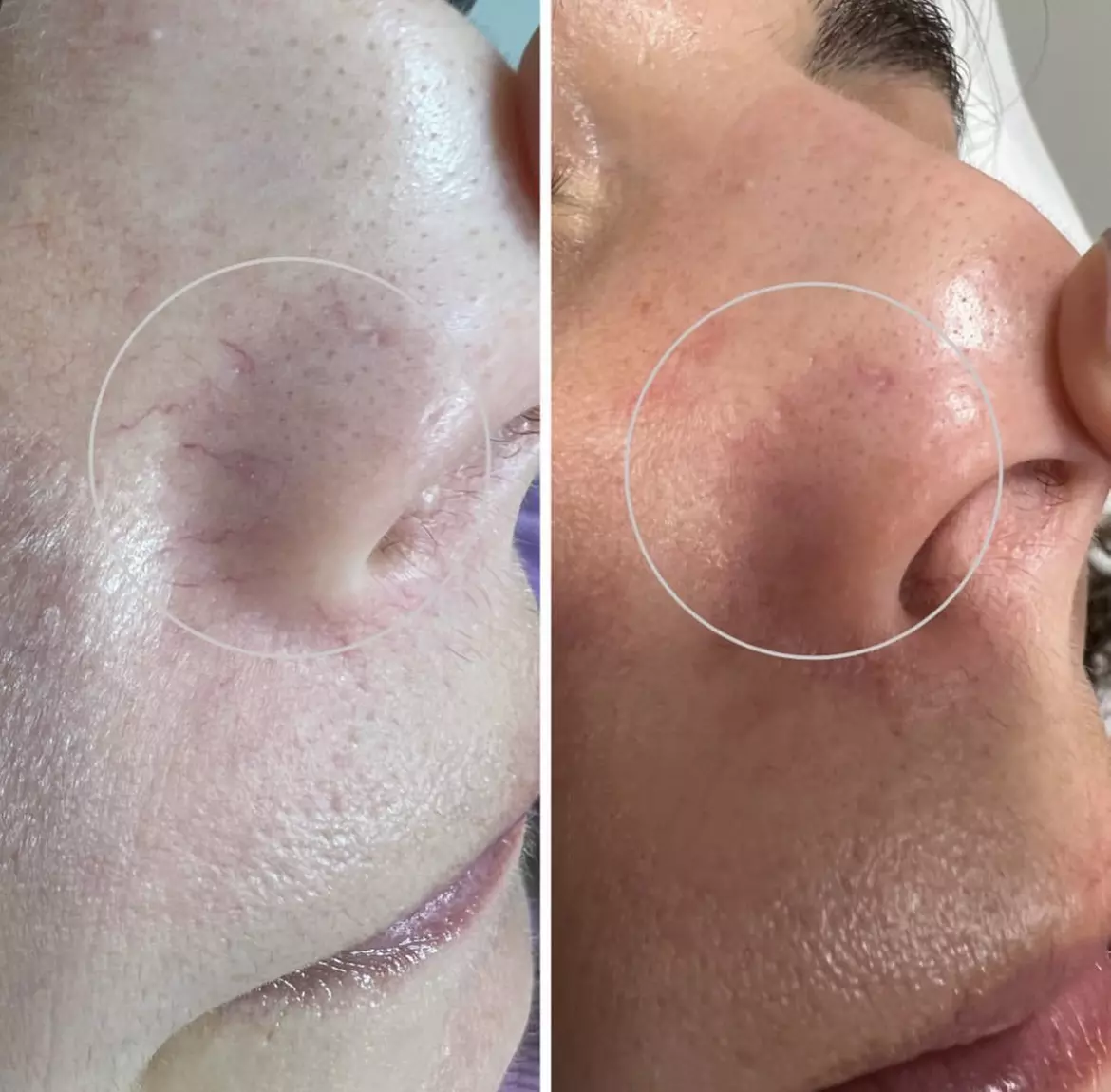 Up to 66% Off on Spider Vein Removal at UDERMA MED SPA & LASER - Primary Image