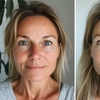 Image 2: Laser Skin Resurfacing Treatment at Rewind Medical Spa by Sharicom Health(Up to 30% Off)