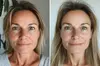 Laser Skin Resurfacing Treatment at Rewind Medical Spa by Sharicom Health(Up to 30% Off)