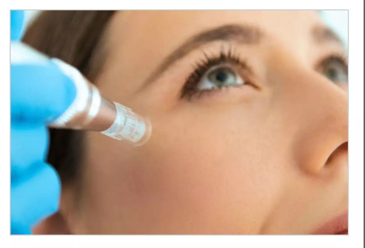 Transform Your Skin With Micro-Needling and Numbing Cream Up to 38% Off at New York subzero wellness - Primary Image