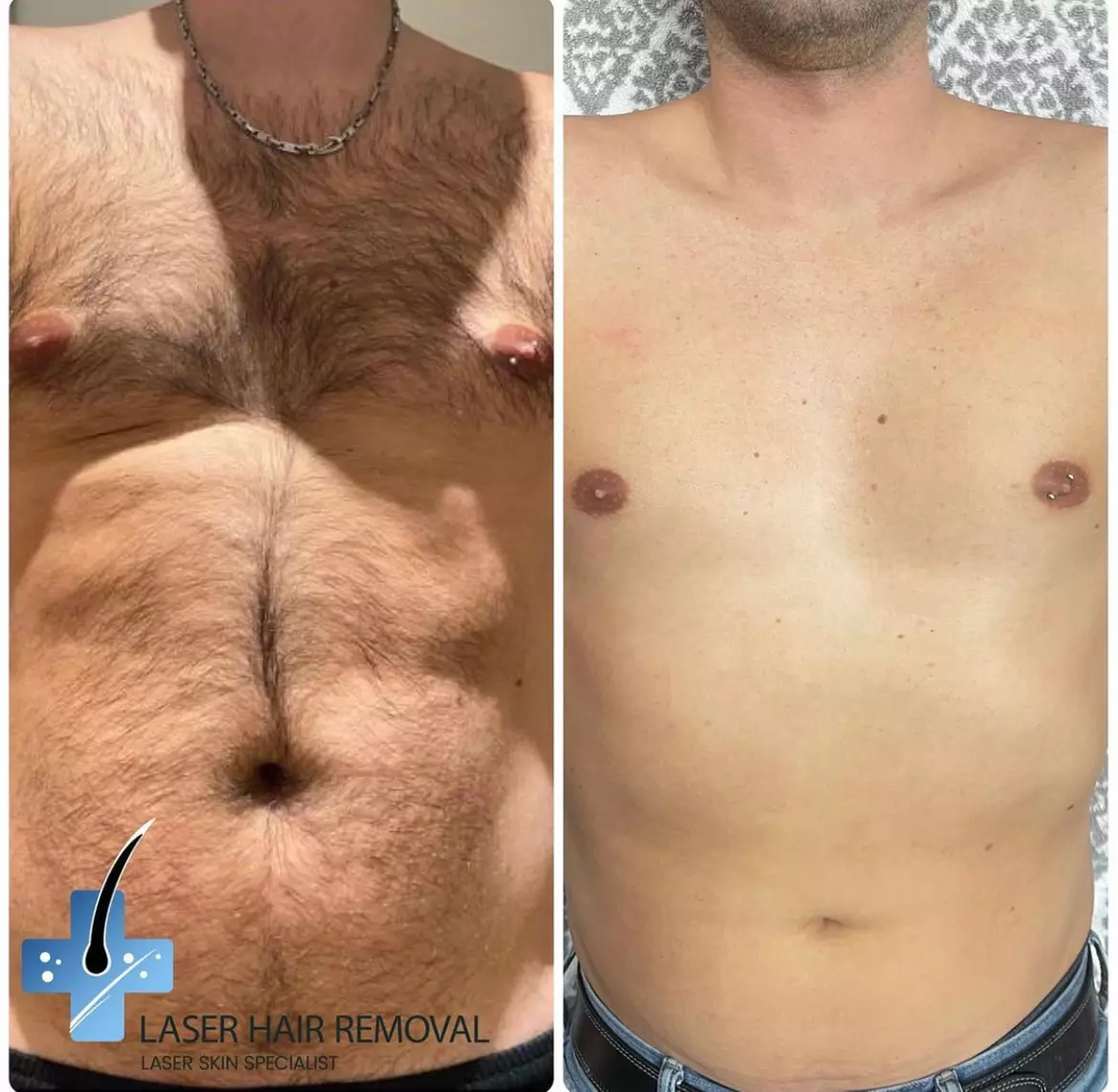 Get up to 50% off on six laser hair removal sessions for small, medium, or large areas - Second Medium