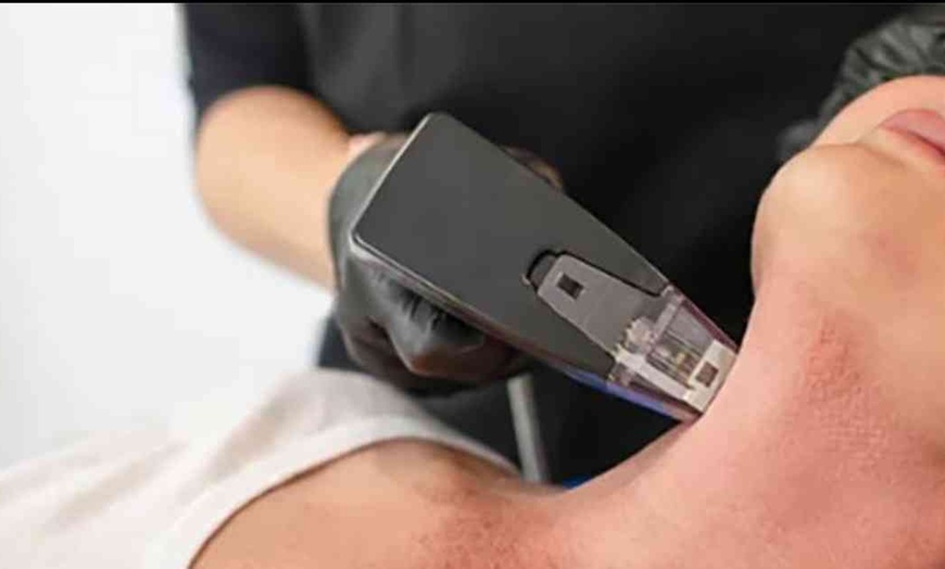 Image 2: Radiant Skin: 60-Minute RF Microneedling for Face & Neck