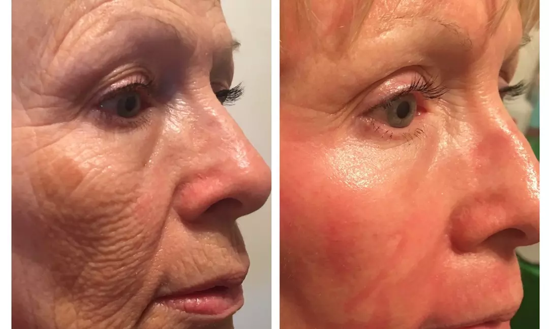 Up to 55% Off on Laser Skin Resurfacing-Unbranded at Divine Dental Spa - Primary Image