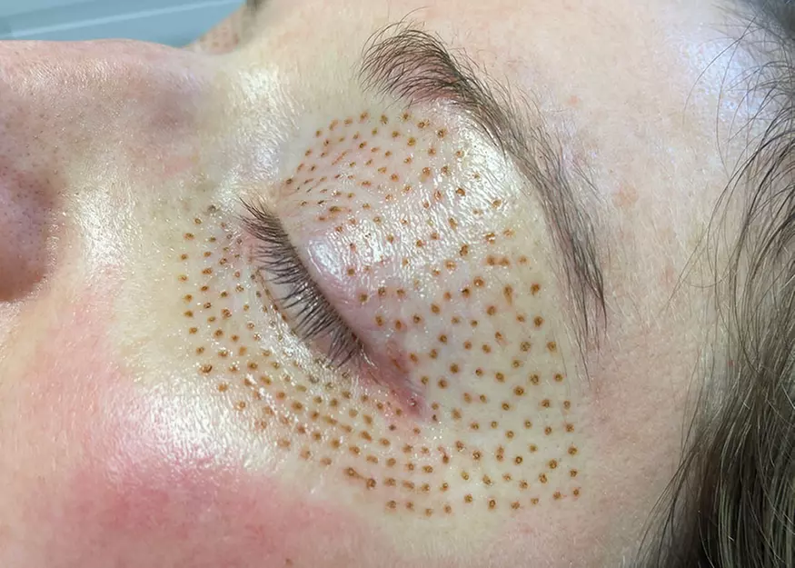 Up to 35% Off on Radio Frequency Skin Tightening at Fibroblast Aesthetics - Primary Image