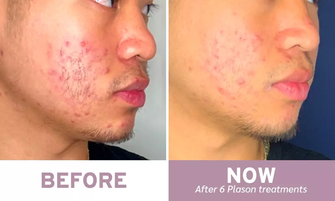 Up to 45% Off on Facial - Pore Care at Beverly Laser & Salon - Second Medium