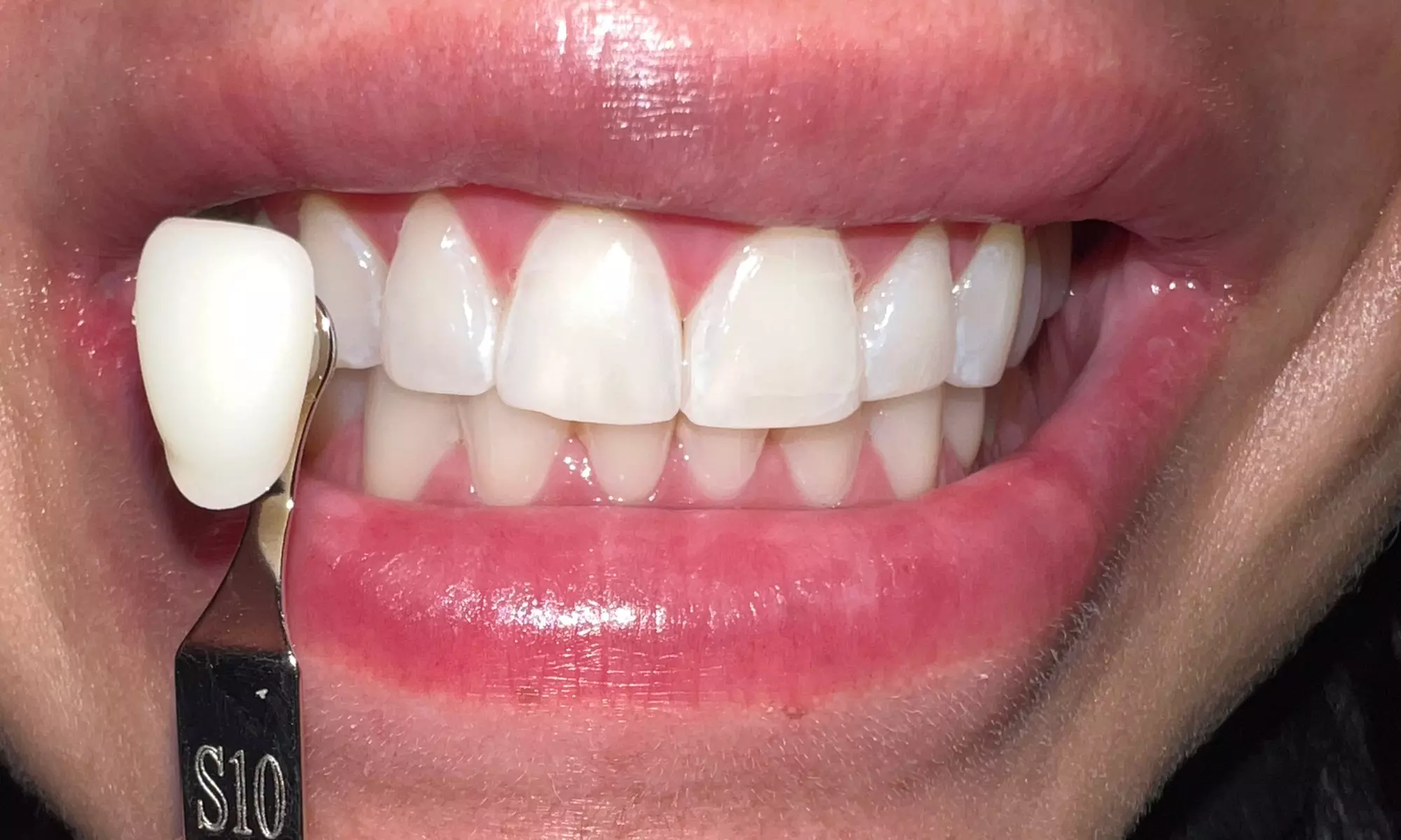 Up to 23% Off on Teeth Whitening at Smiles by Haley - Primary Image