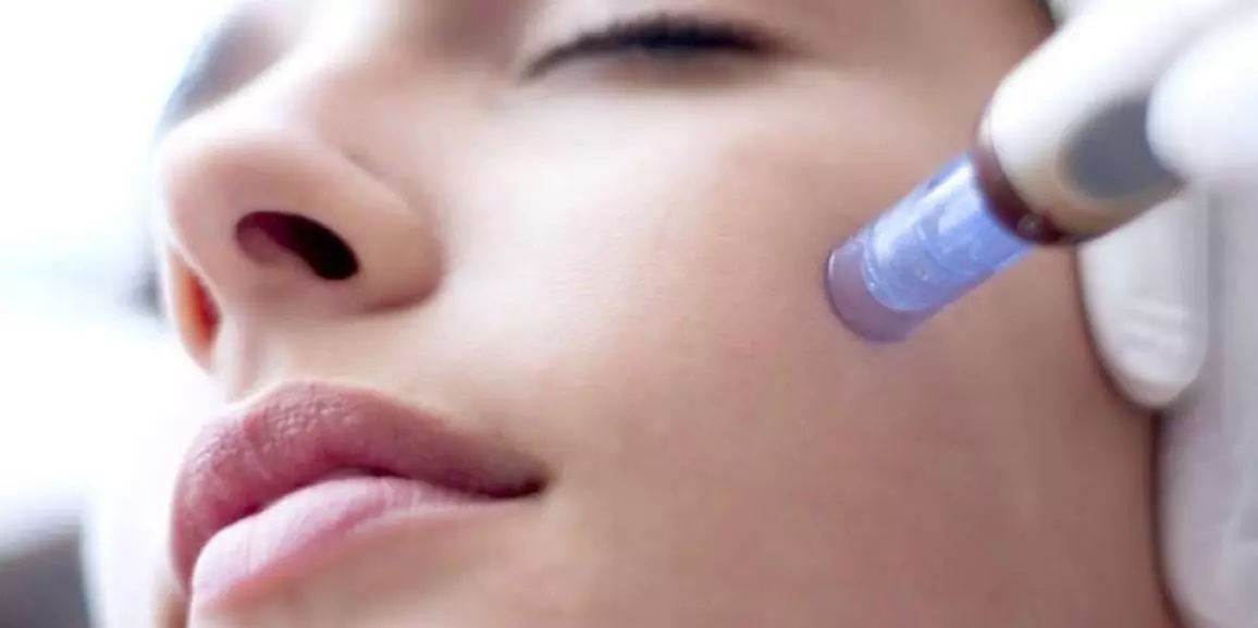 Up to 65% Off on Micro-Needling at Aesthetics On Highland - Primary Image