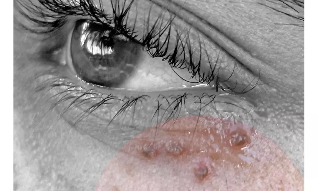 One-Three, Four-Six, and Seven-Nine Skin Tag Removal