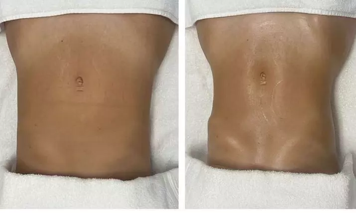 Up to 38% Off on Lymphatic Drainage Massage at Eight30 Body Factory - Second Medium