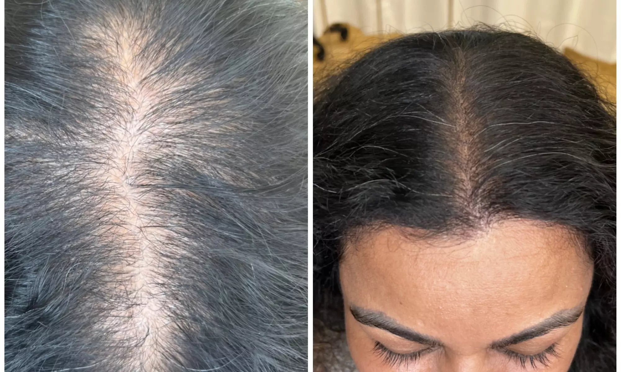 Up to 40% Off on Salon - Scalp Care at DRScalp - Second Medium