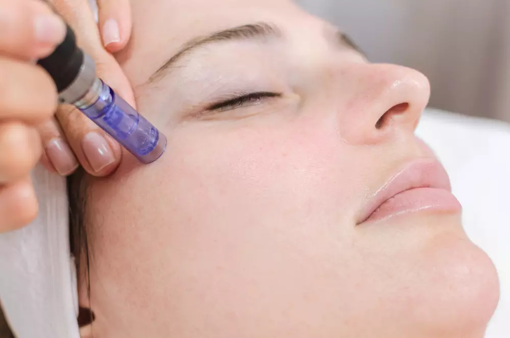 Achieve Youthful Skin: 1 or 3 Microneedling Sessions with Hyaluronic Acid or Vitamins and Get Up to 68% Off - Second Medium