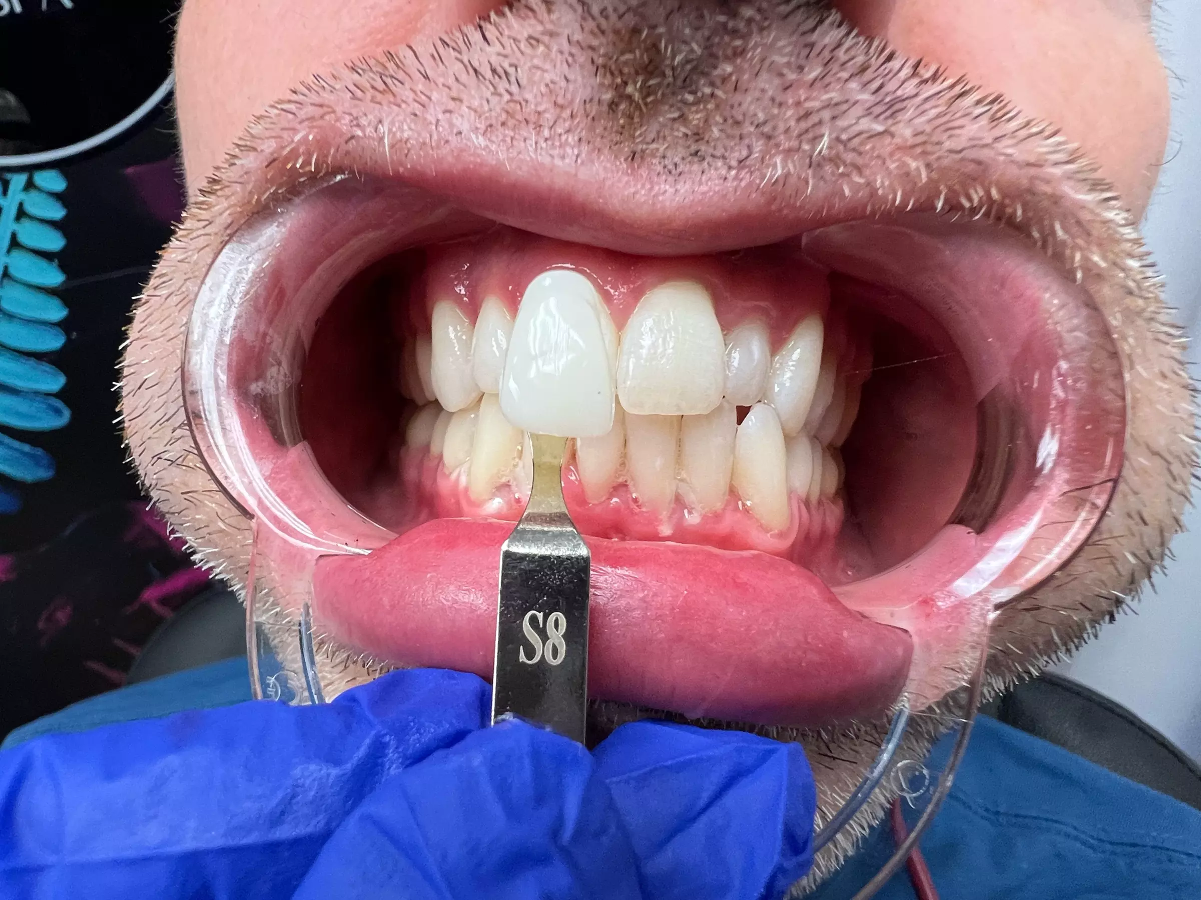 Up to 50% Off on Teeth Whitening - In-Office