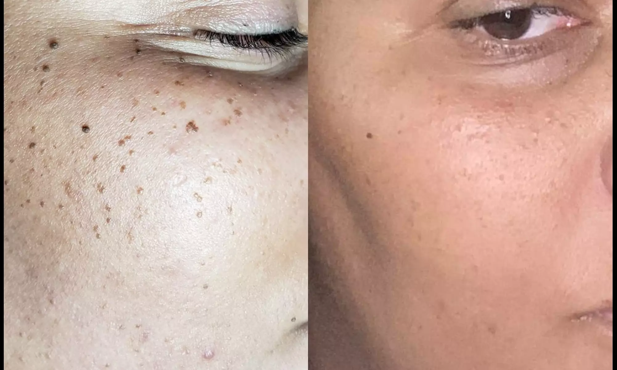 Experience Skindigo Wellness's mole, skin tag & cherry angioma removals with up to 50% off for smooth, clear skin - Primary Image