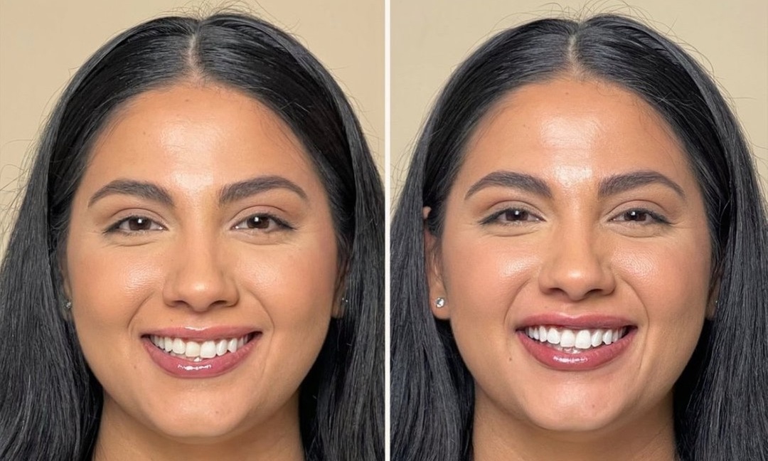Brighten Your Smile with 30-90 Minute Teeth Whitening Options