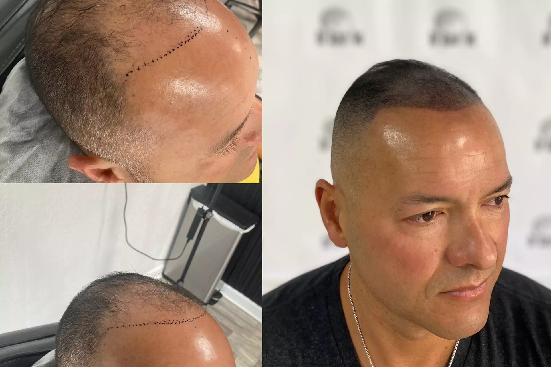 Discover Drscalp Ink's Scalp Micro Pigmentation Options for up to 49% off - Second Medium