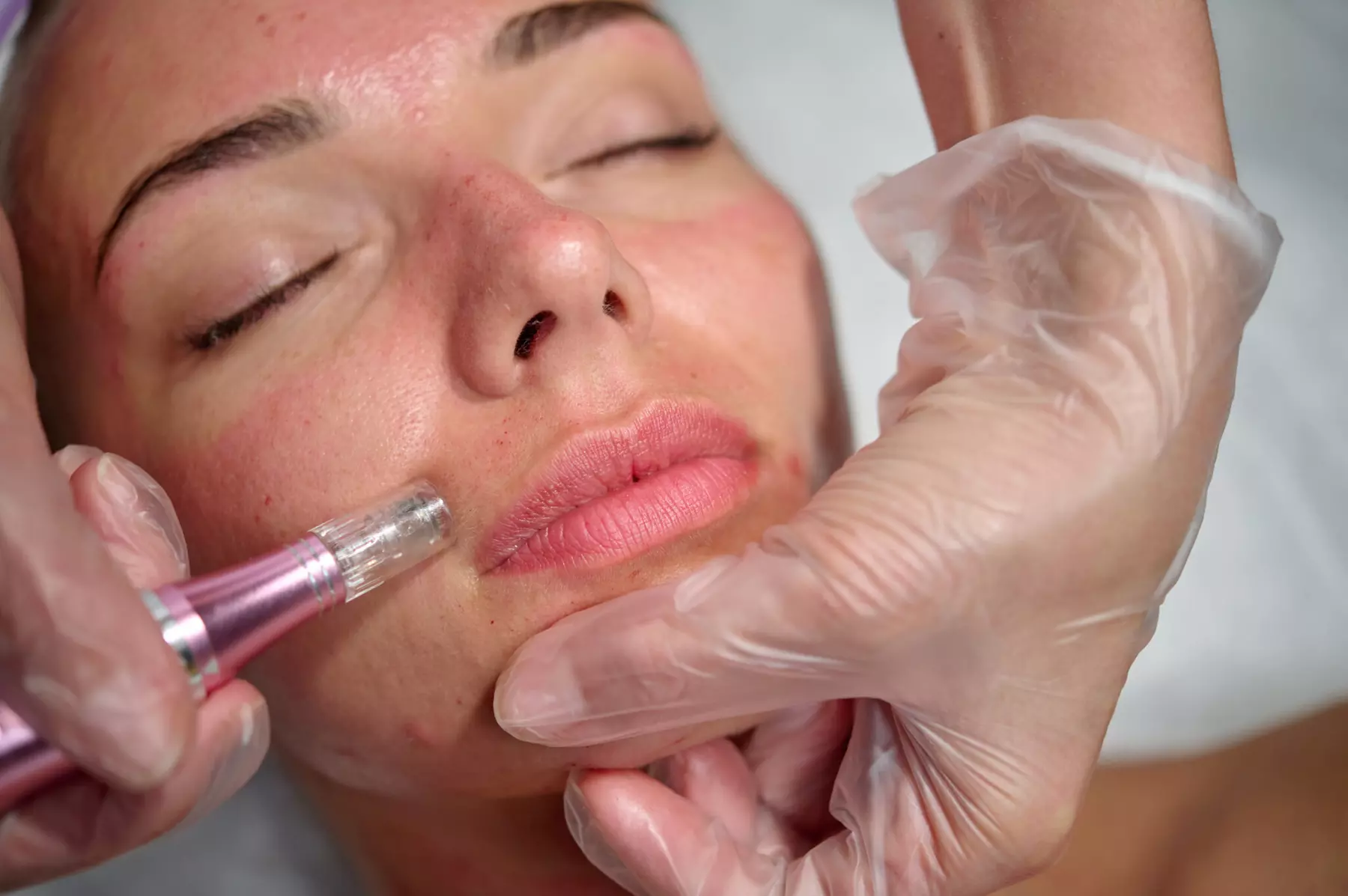 Experience rejuvenating micro-needling at Bella Beauty with serum treatment, up to 45% off for a fresh look - Primary Image