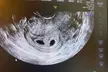 Experience Exceptional Imaging Center's Multi Visit 2D Ultrasound Package with up to 50% off for detailed prenatal memories - Second Medium