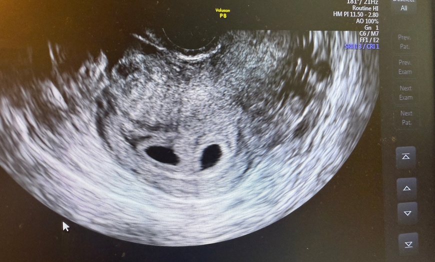 Image 4: Capture Precious Moments with Multi Visit 2D Ultrasound