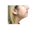 Image 8: Laser Skin Rejuvenation for Face, Neck, or Hands