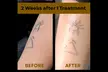 Laser Hair Removal, Laser Tattoo Removal, Laser Carbon Peel, Laser Acne Treatments (Up to 60% Off) - Second Medium