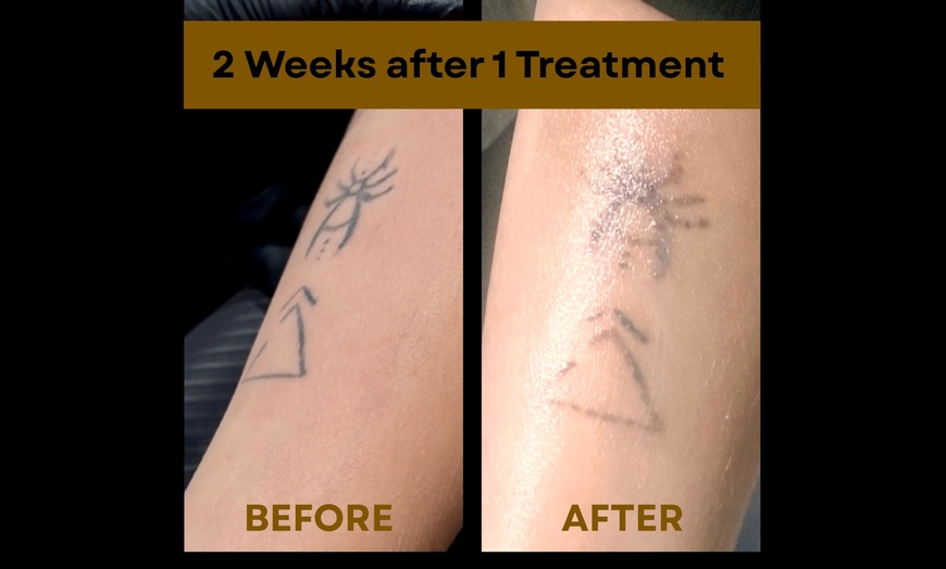 Image 3: Laser Hair Removal, Tattoo Removal, Carbon Peel, Acne Treatments