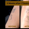 Image 3: Laser Hair Removal, Tattoo Removal, Carbon Peel, Acne Treatments