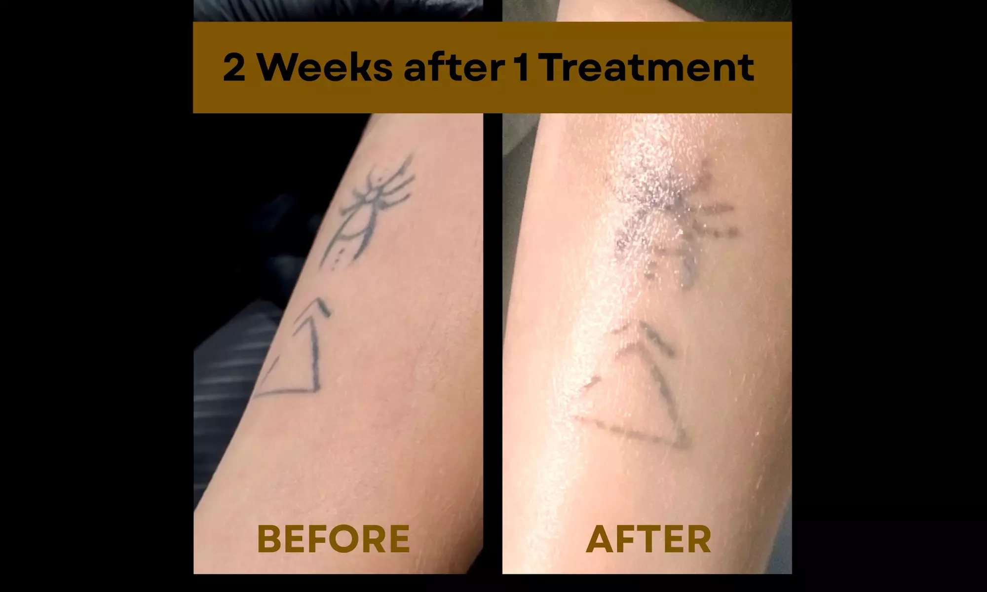 Laser Hair Removal Sessions or Laser Carbon Peel or Acne Treatments