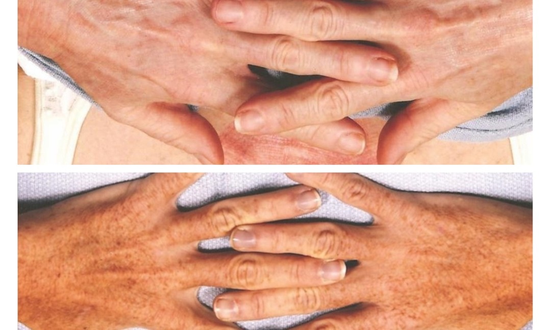 Up to 60% Off on Laser Skin Resurfacing at Rophe Wellness And Weightloss