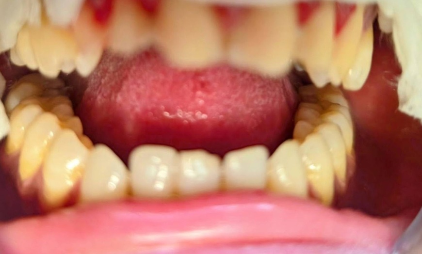 Image 3: Teeth Whitening Branded at Your Covina Family Dentistry