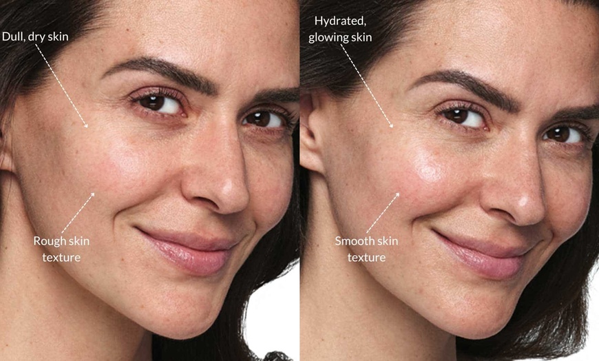 Image 2: Enhance Your Skin with Skinvive Microdroplet Hyalornic Acid Filler