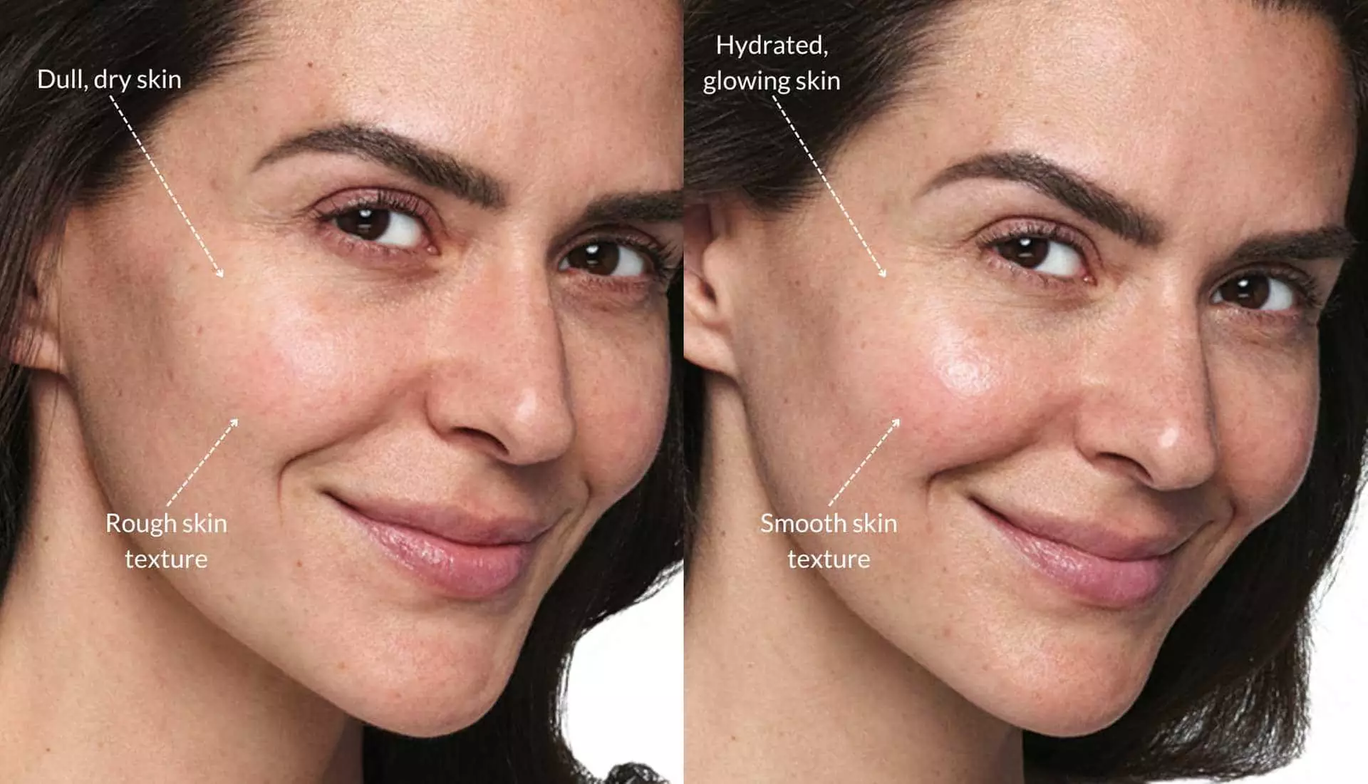 Enhance Your Skin with Skinvive Microdroplet Hyalornic Acid Filler
