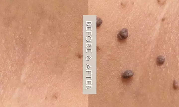 Remove Up To 10 Skin Tags, Moles, Warts Or Milia Up To 2mm