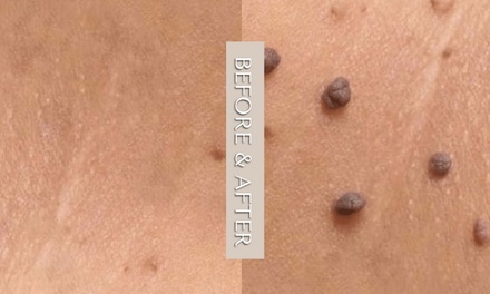 Removal of 1 to 3 Skin Tag, Cherry Angioma, Age Spot, Wart, mole, or Milia (up to 2mm) - Gabriella beauty esthetician
